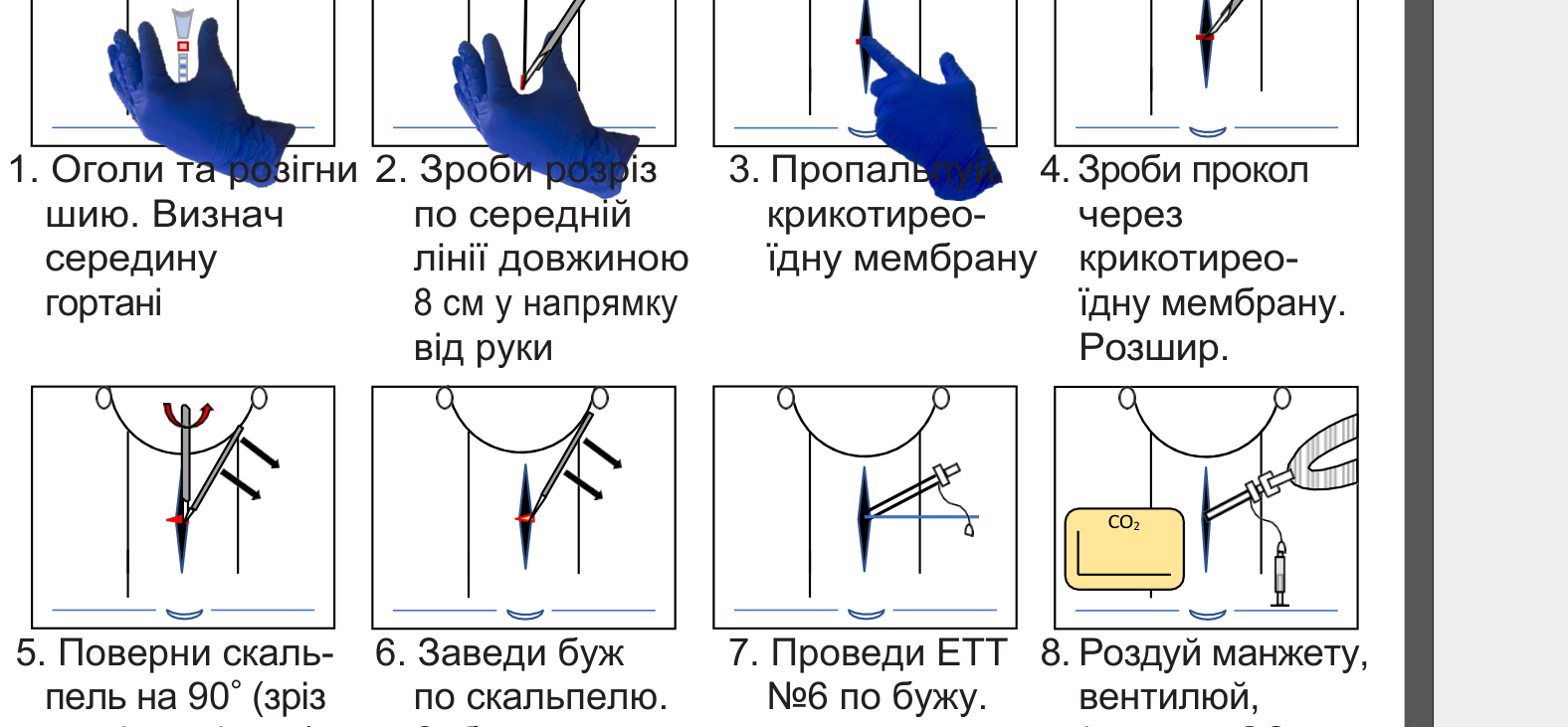 Крикотиреотомія: скальпель — буж — трубка
